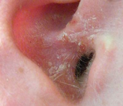 Ear Psoriasis before Prosiasis-Ltd III had been applied