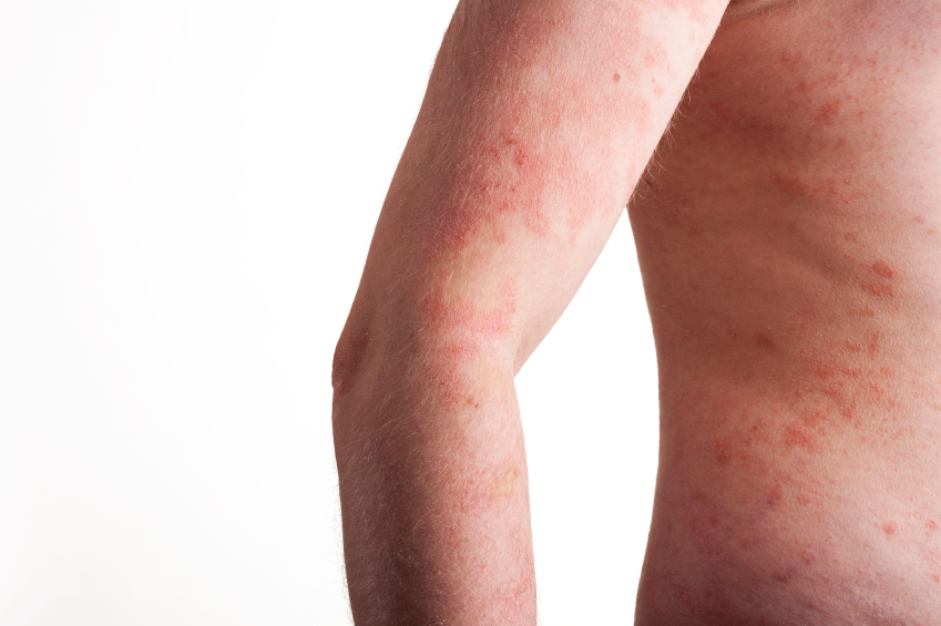 Psoriasis-Ltd III treats psoriasis's rash